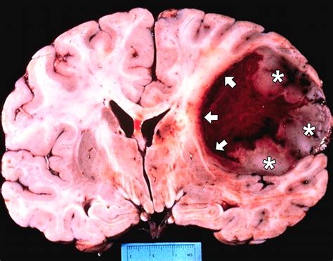 Glioblastoma And Brain Cancer Neuro News And Cosmo Clues
