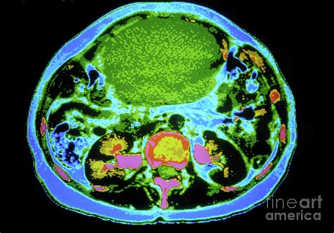 Coloured Ct Scan Showing A Large Ovarian Cancer Photograph By Gjlp