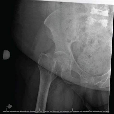 Ap Radiograph Of The Right Hip Demonstrating A Displaced Femoral Neck