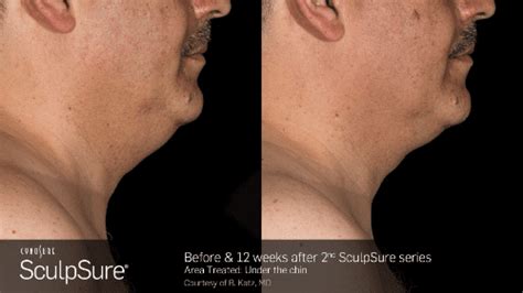 Sculpsure Before And After Nashville Tn