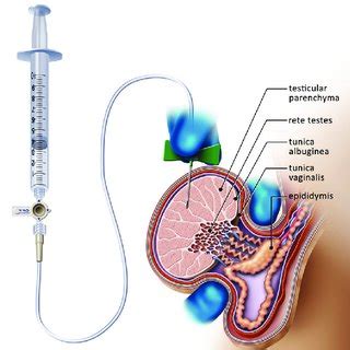 Testicular Fine Needle Aspiration Technique For The Collection Of