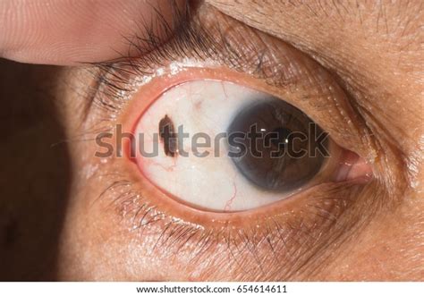 Close Conjunctival Nevi During Ophthalmic Examination Stock Photo Edit