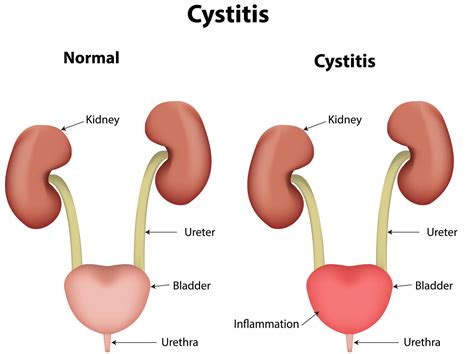 Candiduria Candida Cystitis And Urinary Tract Candidiasis Fungal