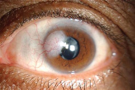 Corneal Opacity Treatment Synergy Eye Care