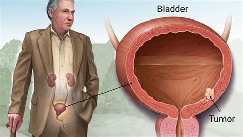 Bladder Cancer Advanced Urology