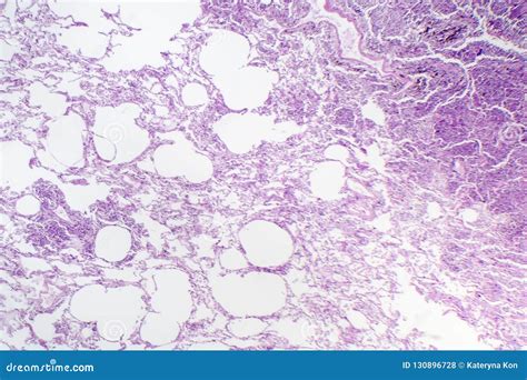 Histopatologia Da Pneumonia Intersticial Foto De Stock Imagem De