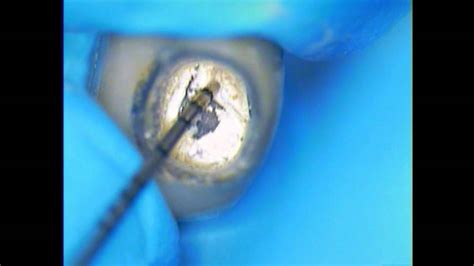 Dental Implant Broken Screw Retrieval Method 1 Biomet 3i Case Youtube
