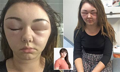 Sales Coordinator Blinded After Allergic Reaction To Hair Dye