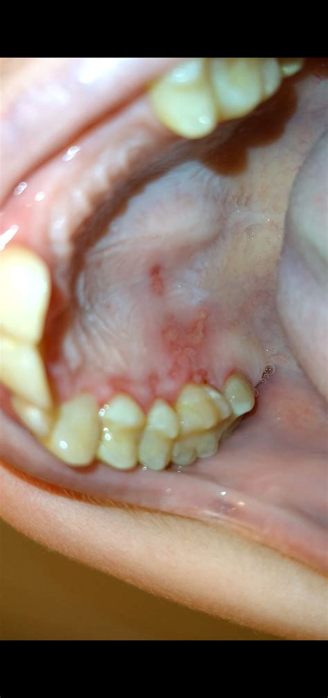Pic Are These Canker Sores On Roof And Gums Too Painful To Eat Had
