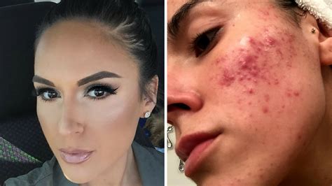 My Acne Journey How I Cleared My Skin Without Accutane Youtube