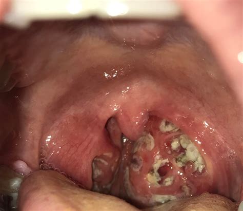 Thought I Had Strep Turns Out Its A Tonsil Abscess Doc Told Me To Go