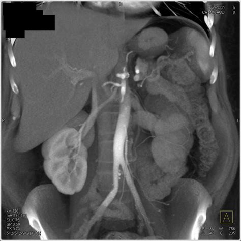 Occluded Stent In The Celiac Artery Vascular Case Studies Ctisus Ct