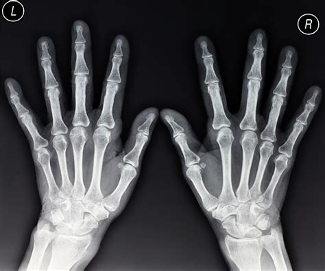The Importance Of Radiopaque Markers In Digital X Ray