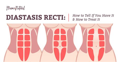 How To Know If You Have Diastasis Recti And What To D Vrogue Co