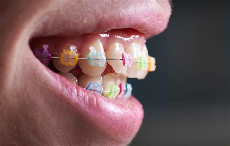 Best Braces Colors Smilebliss