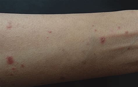 Multiple Erythematous Papules With Micaceous Scales On The Upper