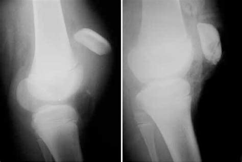Pre And Postoperative Radiographs On The Right Knee Download