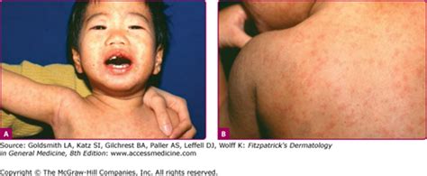 Chapter 192 Exanthematous Viral Diseases Fitzpatricks Dermatology