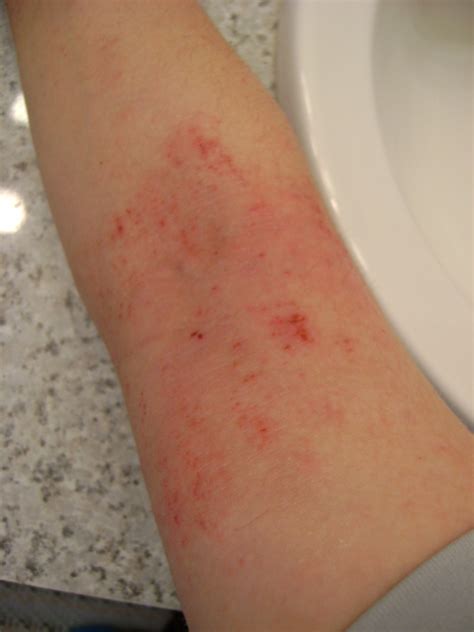Gallery For Eczema On Arm Crease