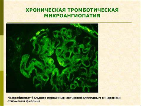 Диета хронический гломерулонефрит Мембрано-пролиферативный гломерулонефрит - презентация онлайн Мембрано-пролиферативный гломерулонефрит - презентация онлайн Диета хронический гломерулонефрит