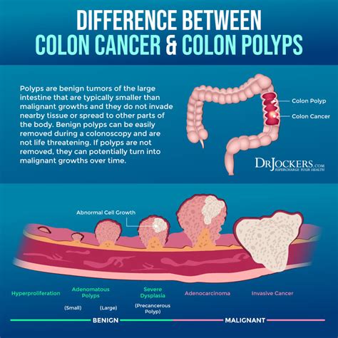 Colon Cancer Symptoms Causes And Support Strategies