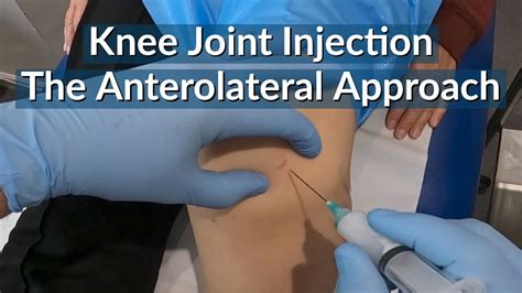 Knee Joint Injection The Anterolateral Approach Instructional Video