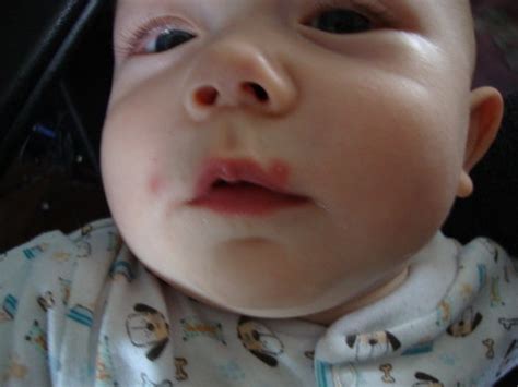 What Are These Sores Around My Babys Mouth Pic Babycenter
