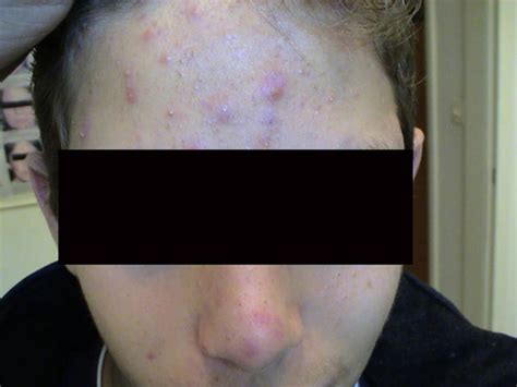 Diseases Of The Sebaceous Glands Acne Vulgaris Picture Hellenic