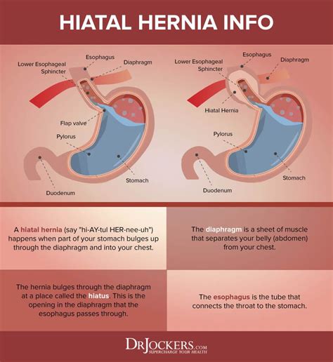Hiatal Hernia What It Is And Natural Treatments Acid
