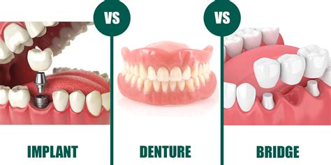 What Is Better Implant Or Bridge Or Gap Royal Dental Clinics Blog