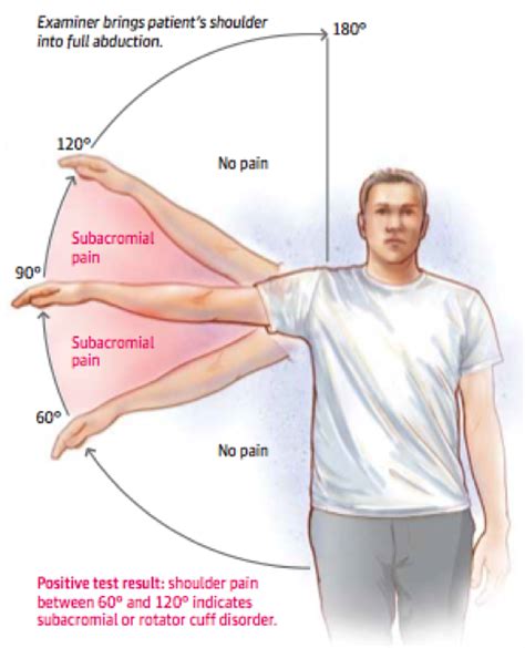 Subacromial Shoulder Impingement Syndrome Artofit