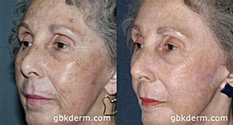 Age Spots Causes Risk Factors And Treatment Options Essence Medispa Cosmetic Dermatology