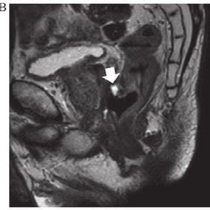 Penetration Of The Anterior Rectal Wall To The Retroperitoneal Space