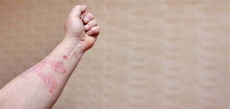 Man With Sick Arm Dry Flaky Skin On His Hand With Vulgar Psoriasis