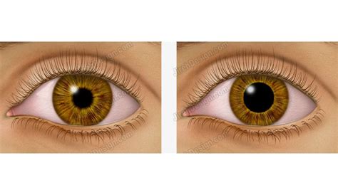 Pupil Dilation Illustrated Depicting Large And Small Pupil