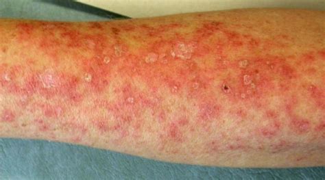 Cutaneous Lupus Erythematosus After Treatment With Paclitaxel And