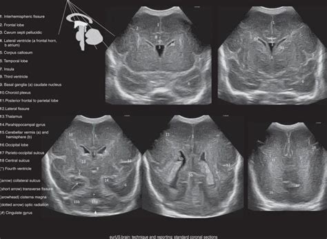Pin On Neonatal Head Sonogram
