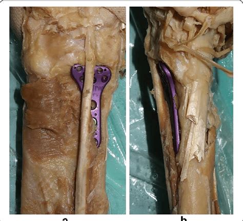 Injuries to tendons are particularly difficult to recover from due to the limited blood supply they modern humans are unique among hominids in having a flexor pollicis longus (fpl) muscle belly that. a Plate placement viewed from the front. Flexors except the flexor... | Download Scientific Diagram