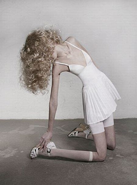 Anorexia Its Terrifying 14 Pics Izismile Com