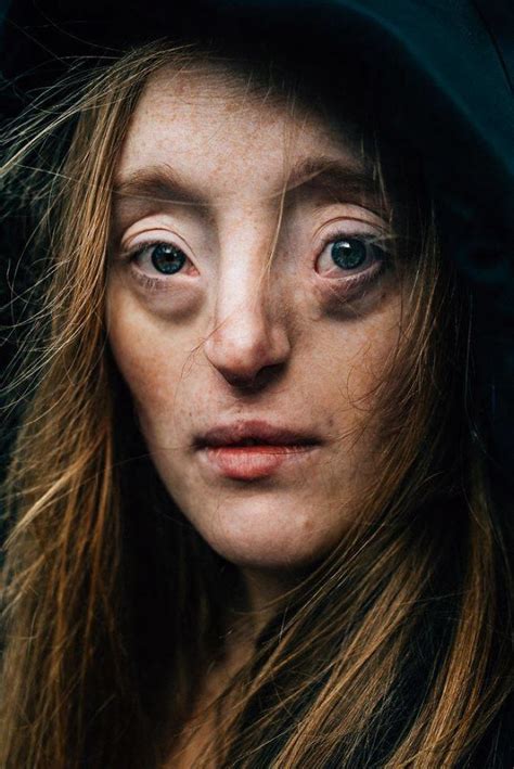 26 Year Old Born With Extremely Rare Facial Defect Is Breaking Beauty