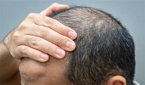 Symptoms Cause And Treatment Of Male Pattern Baldness Healthy Mens