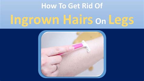 Treatment options for thigh/leg ingrown hair infection. how to get rid of ingrown hairs on legs | Sugar & Honey ...