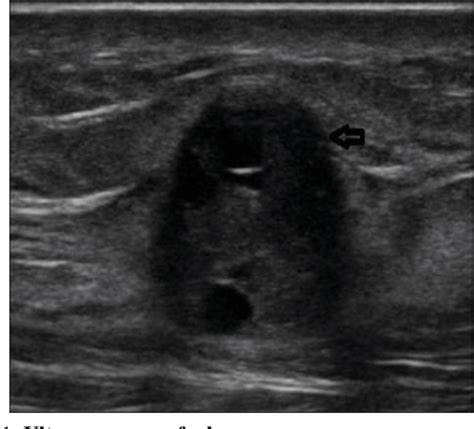 Figure 1 From A Rare Presentation Of Supraclavicular Schwannoma