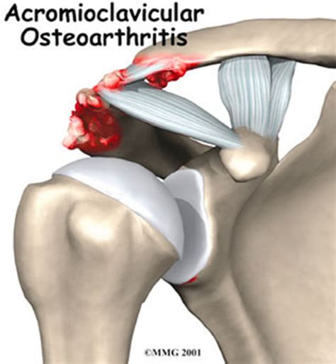Acj Arthritis Brisbane Knee And Shoulder Clinic Dr