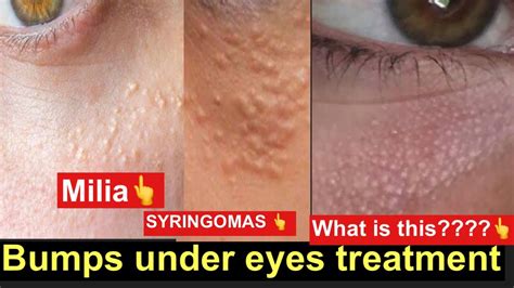 Bumps Under Eyes What Are They And How To Get Rid Of