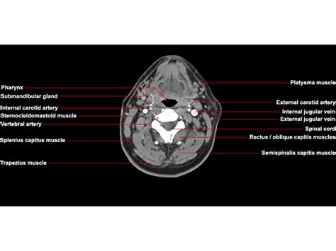 Ct Neck Axial Anatomy Radiologypicscom