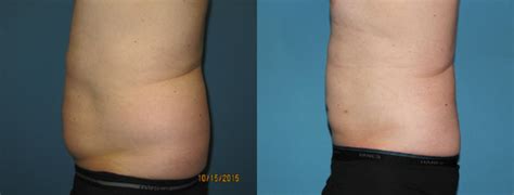 Liposuction Abdomen Flanks Before And After Pictures Case