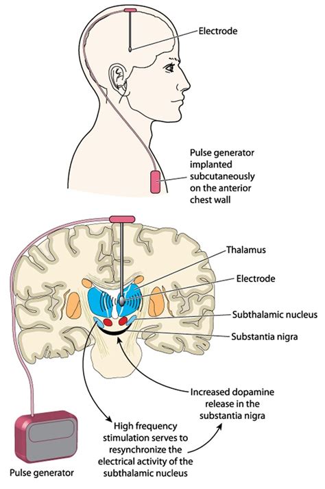 What Does Deep Brain Stimulation Involve