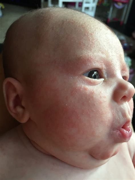 Newborn Skin Rash Whats That On Your Newborns Face
