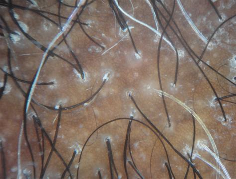 Trichoscopy Of Central Centrifugal Cicatricial Alopecia Donovan Hair